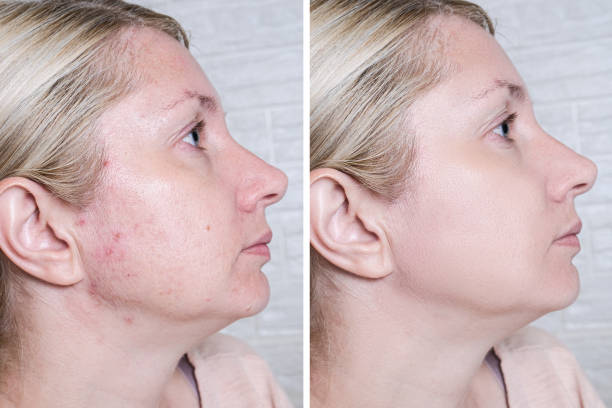 BLISS - Nettoyeur Facial Sonique